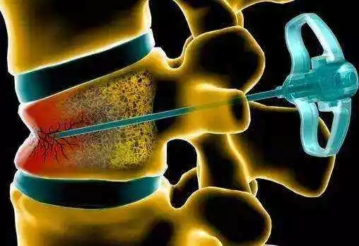 老年人骨质疏松腰椎压缩性骨折,老年骨质疏松腰椎骨折怎样康复