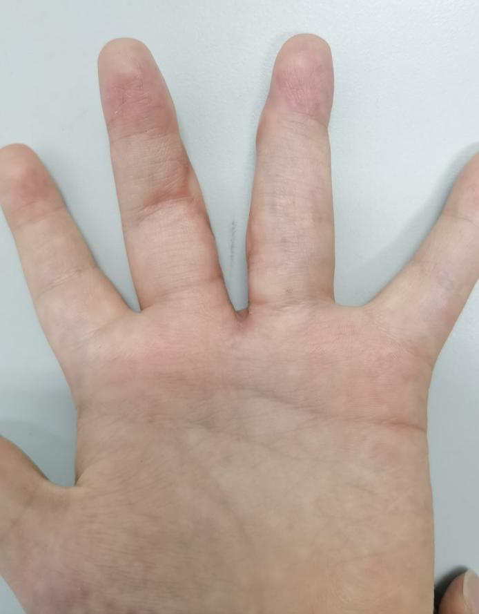 并指畸形免植皮案例,并指畸形