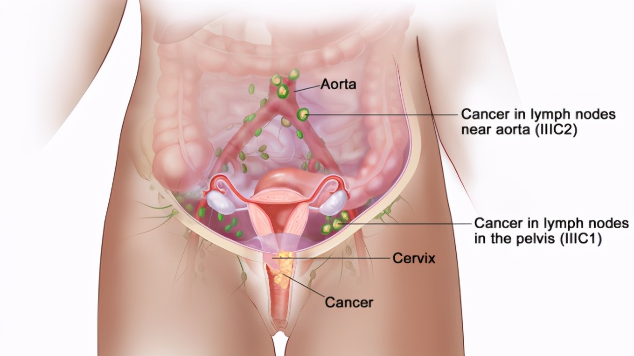 早期癌症会大出血吗,早期癌症如何发现