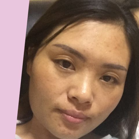 脸上的痘痘印子怎么去除小技巧,怎样去除脸上的痘痘最快最有效