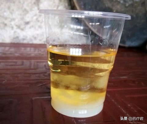 高血压肾病的早期表现尿色深,肾病综合征尿色发白正常吗