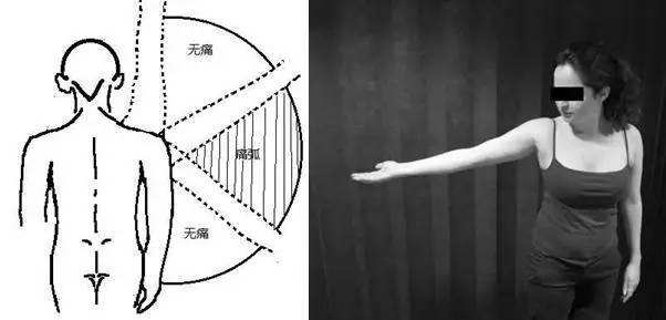 冈上肌损伤和肩周炎治疗方案,肩周炎冈上肌损伤怎么锻炼