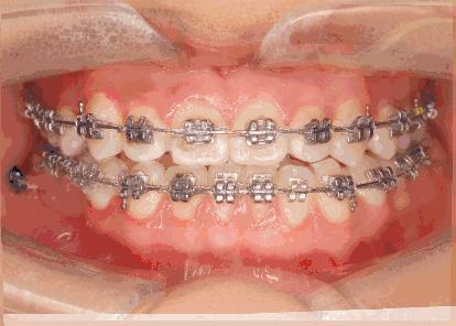 下牙不整齐如何自动矫正不戴牙套,半口牙矫正下排牙缝大