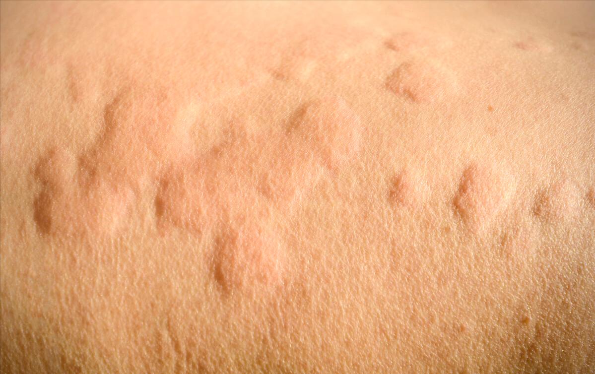 *麻疹荨**患者的饮食禁忌！并不是永久忌口，只是暂时不能吃