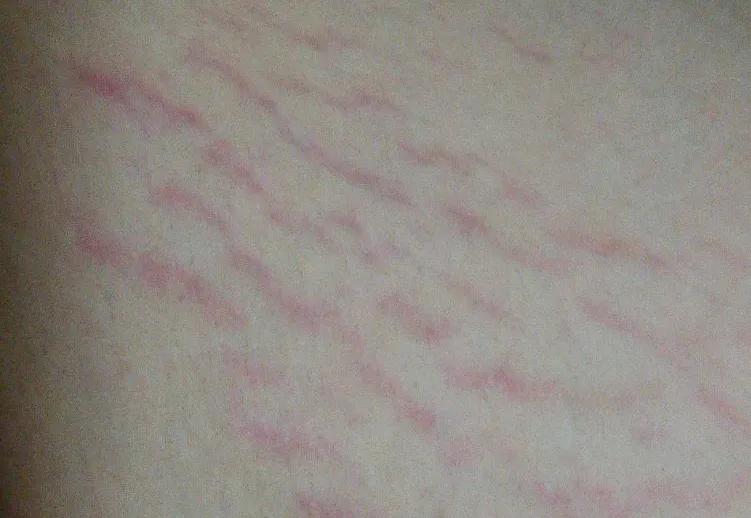 肥胖纹是不是皮肤弹性不好,肥胖纹有感觉吗