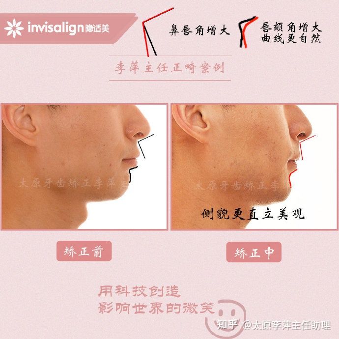 重度拥挤矫正牙齿适合隐形牙套吗,广州成人牙齿矫正推荐隐形牙套