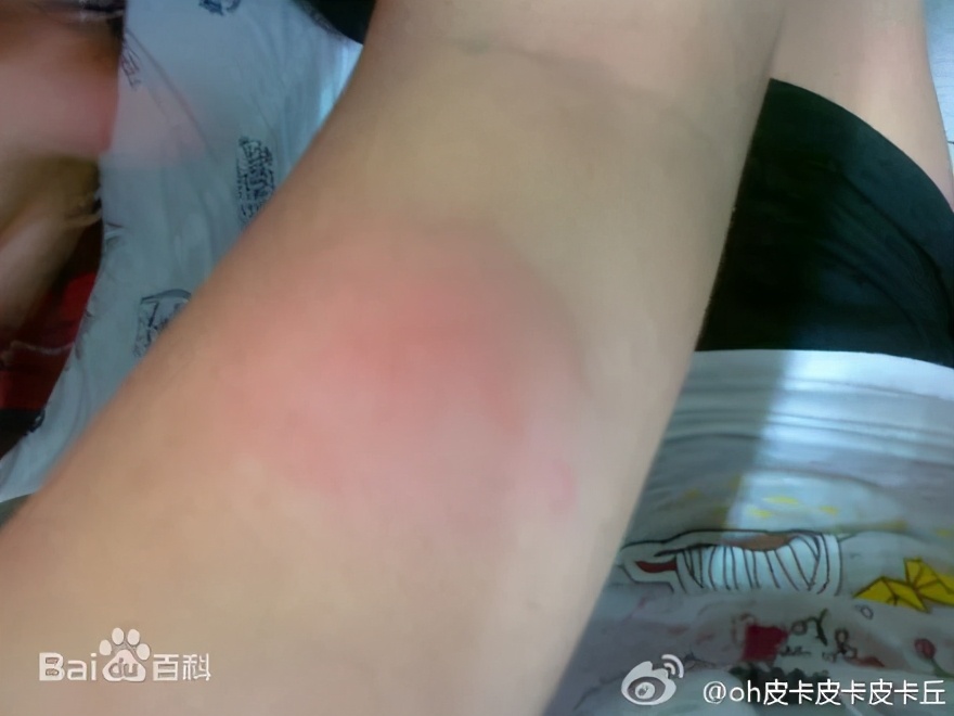 夏日出游被蚊子咬,春天孩子被蚊虫叮咬