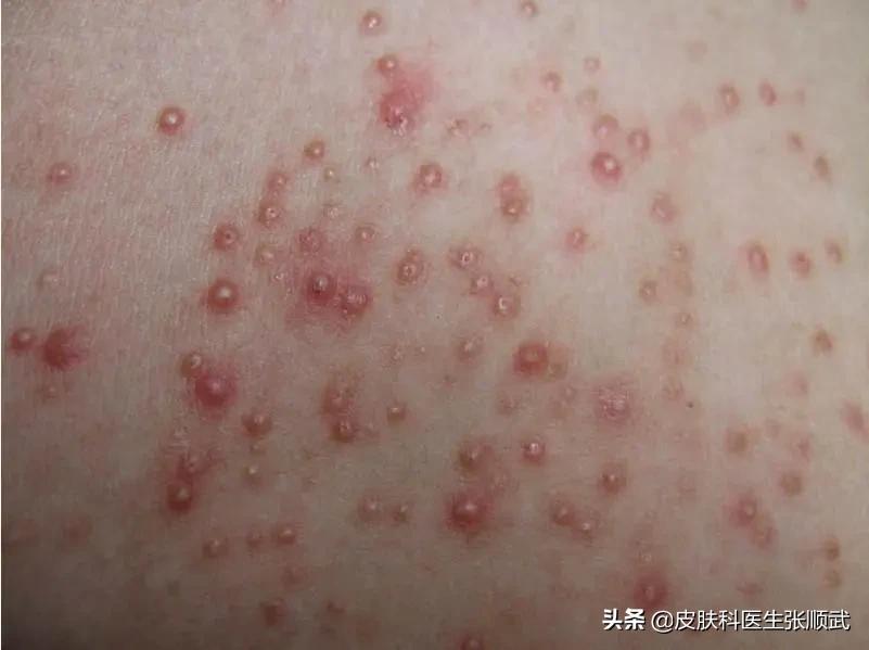 红肿发痒还会流脓，可能是毛囊炎在作怪