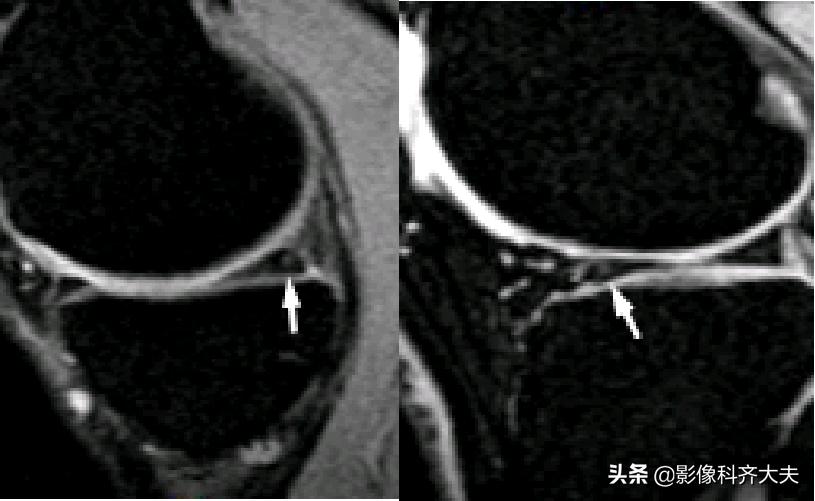 膝关节半月板损伤的磁共振,膝关节半月板病变的mri诊断与鉴别