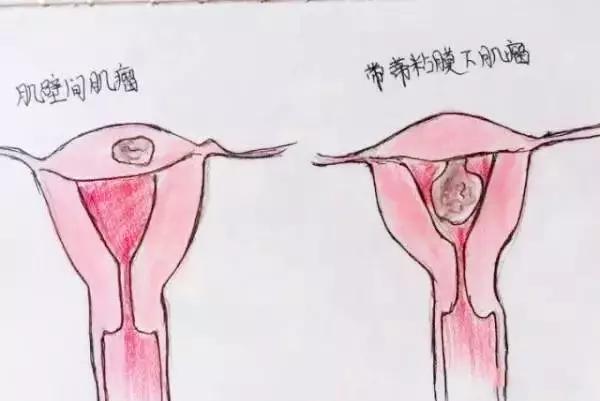 医生精美手绘图片大全,宫颈息肉红蓝铅笔手绘图