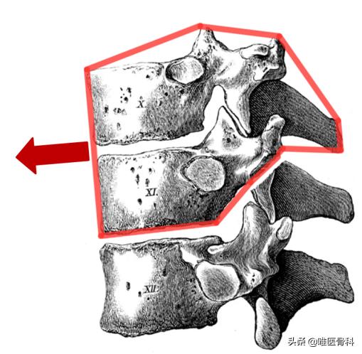 腰椎滑脱的十大危害,腰椎滑脱如何做出准确诊断
