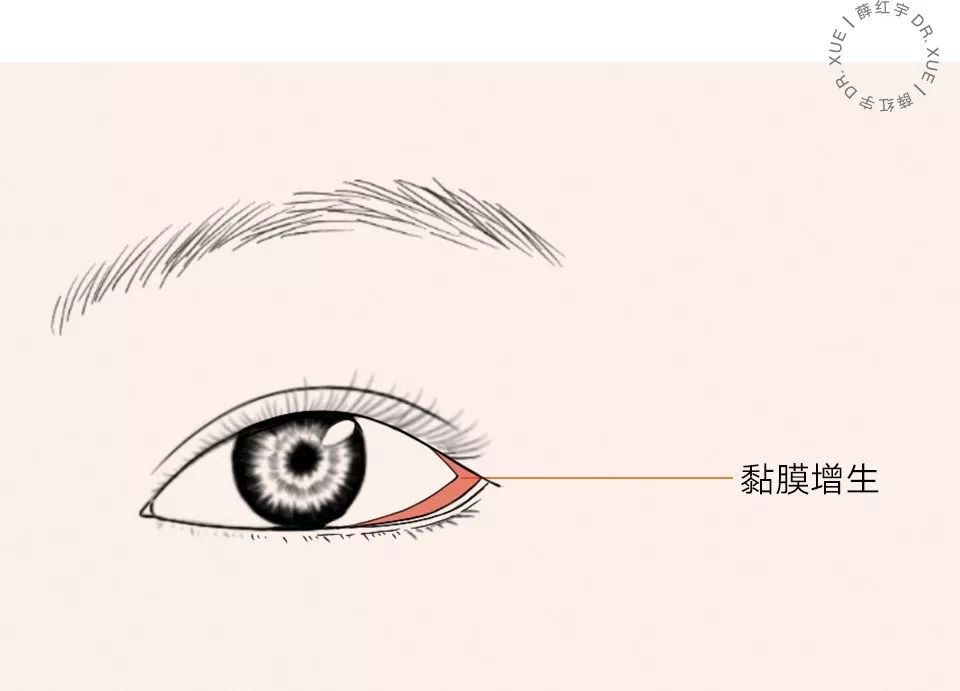 要不要开下眼睑,要不要开内眦赘皮