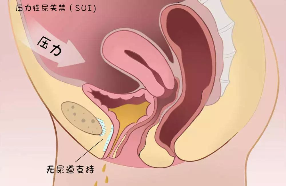 打喷嚏就漏尿应该怎样改善,打喷嚏就漏尿失禁