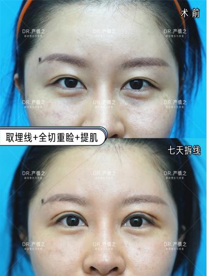 没有内眦赘皮可以开内眼角么,有内眦赘皮不开眼角只割双眼皮