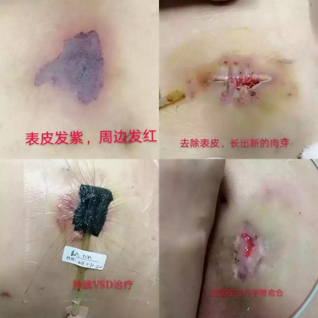 低分子肝素一次注射多少,低分子肝素注射的注意事项