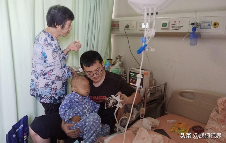 小孩摔一跤后引起眼袋淤青,2岁多男宝眼袋浮肿有点发紫