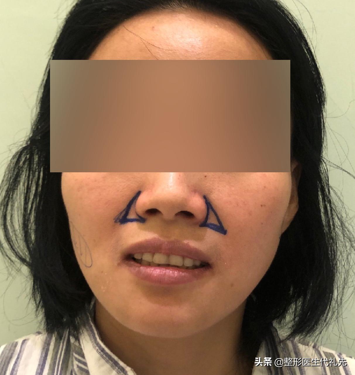 拉皮手术能改善法令纹眼角纹吗,大拉皮手术专门去法令纹怎么做