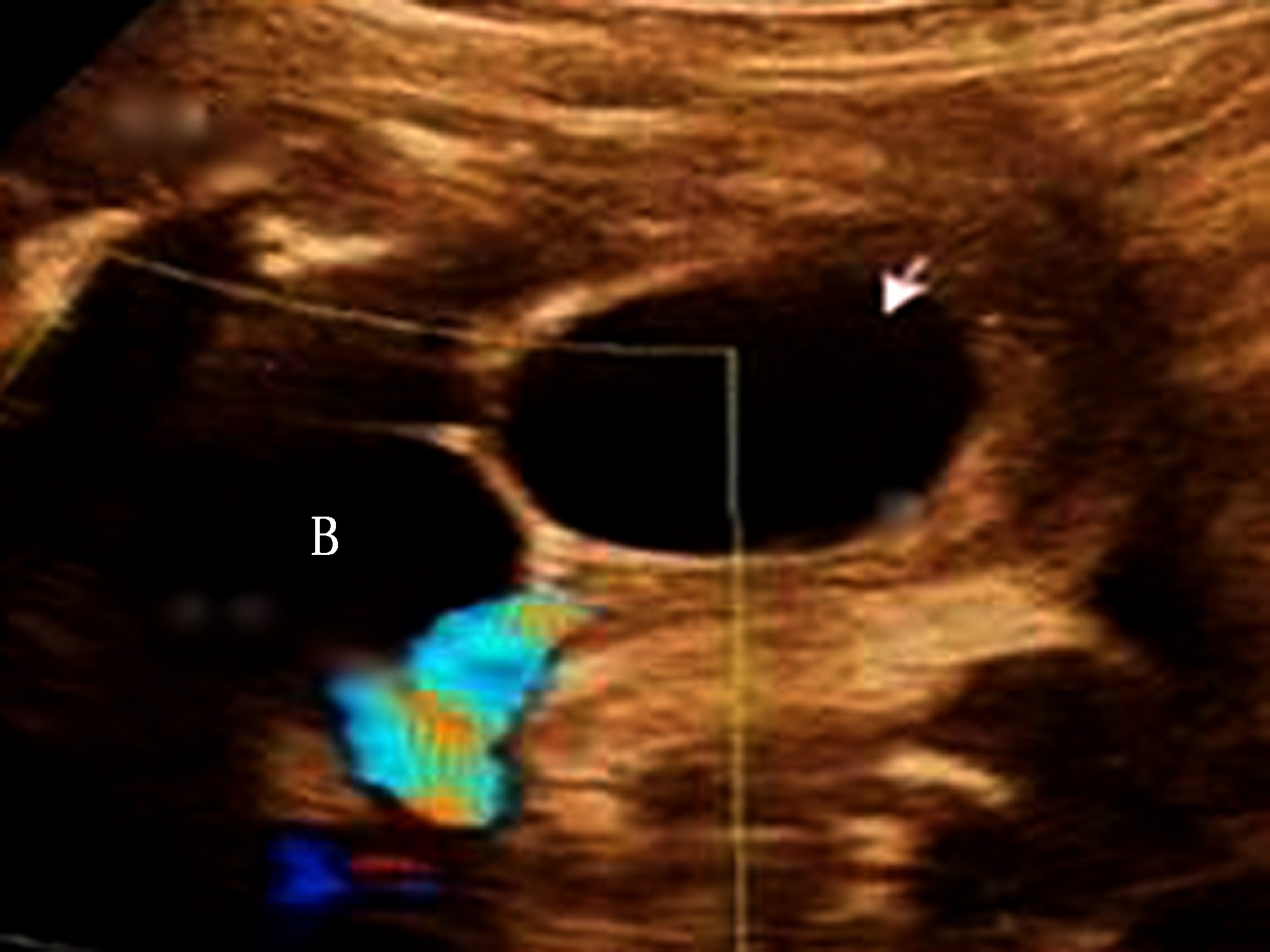 胎儿腹部可见6公分囊性包块,胎儿腹部有肿块怎么回事