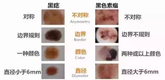 黑痣癌变这个痣是突然出现的么,黑痣凸起会诱发痣癌变是真的吗