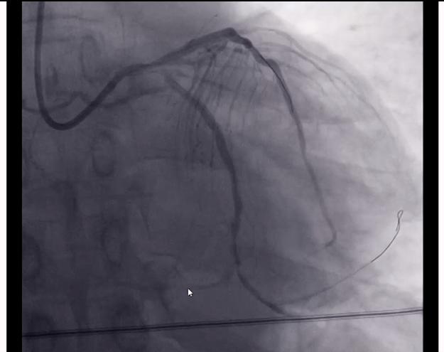 胸闷胸疼心脏彩超心电图ct没问题,胸疼但是心电图正常