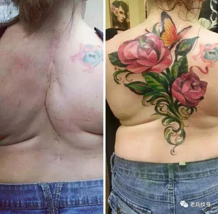 疤痕体质可以用纹身去遮盖疤痕吗,你的疤痕是什么颜色呢