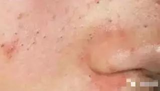 鼻子上的黑头越来越多怎么办,脸上黑头越来越多