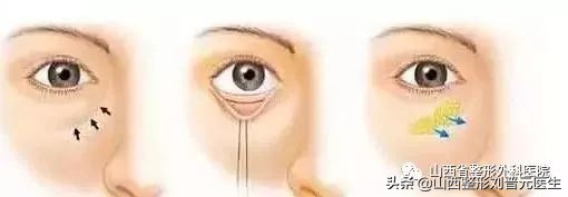 46岁做眼袋还需要做卧蚕吗,现在都把眼袋叫卧蚕了吗