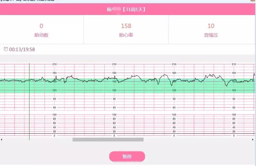 脐带绕颈36周注意事项,33周脐带绕颈两圈怎么处理