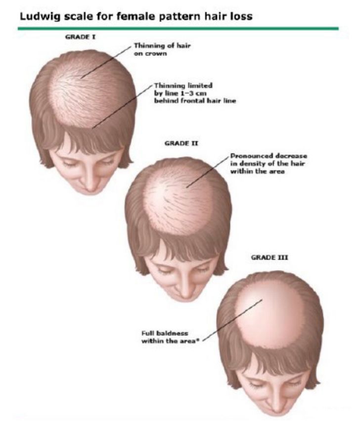 怎样辨别自己脱发,脱发判断最简单的方法