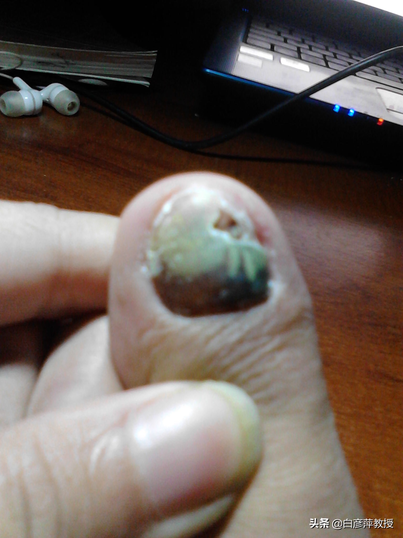 灰指甲是灰色的吗？灰指甲真的会传染吗？皮肤科医生告诉你