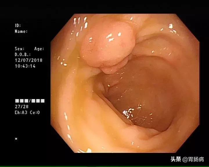 大肠息肉—藏在肚子里的定时*弹炸**，只要发现，必须格杀勿论！