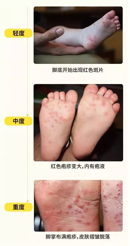 多地流感病人爆发如何预防,如何预防下一场流行病的爆发