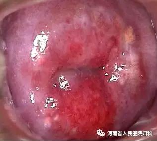 你知道什么是宫颈糜烂吗?