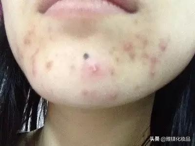 脸上部位长痘痘的原因分析图,脸上哪个部位长痘痘代表什么