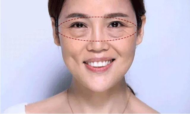 眼角皱纹最显老要注意防晒,眼角皱纹去皱最有效的方法