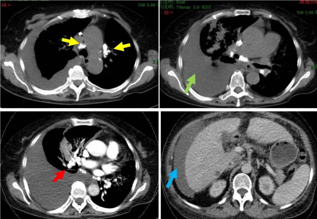 无明显诱因咳嗽、呼吸困难，大量胸腔积液，竟与妇科肿瘤有关？