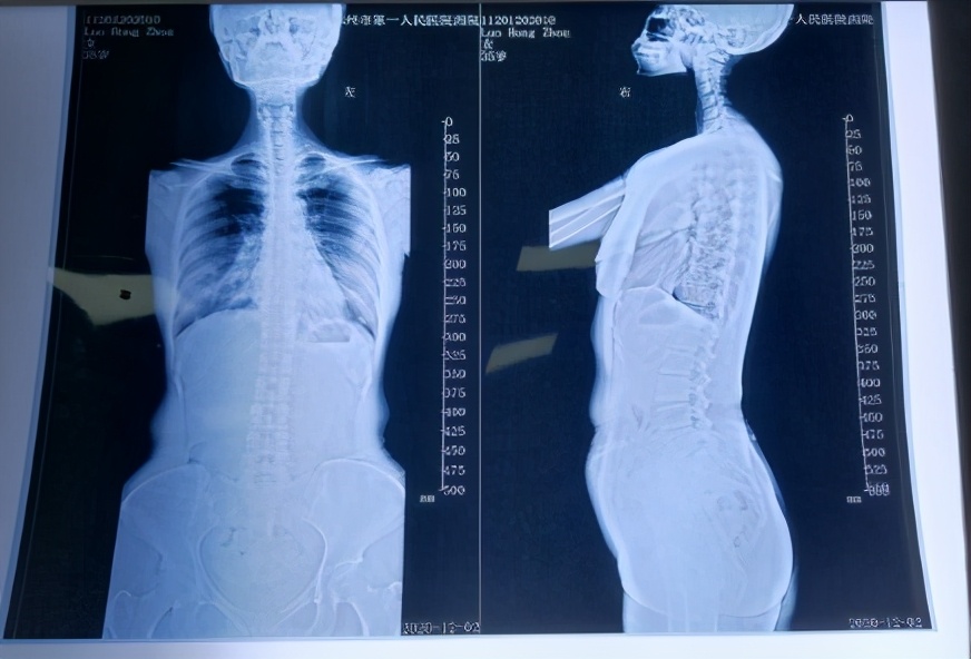 腰骶疼痛最佳治疗方法,腰坐骨神经疼了好多年怎么办