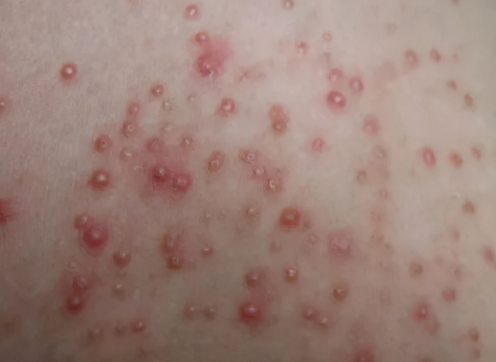 长痘女生的痛苦,体会长痘的痛苦