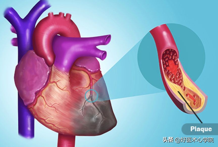 最常见的血栓类型是,最致命血栓视频
