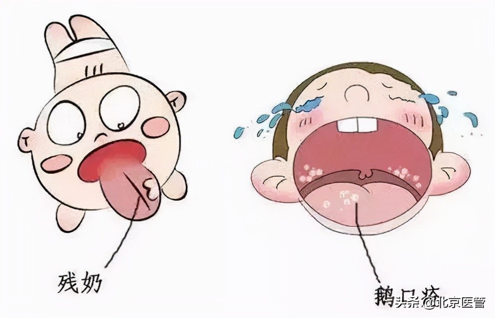 宝宝得了鹅口疮怎么解决,宝宝鹅口疮最佳解决方法