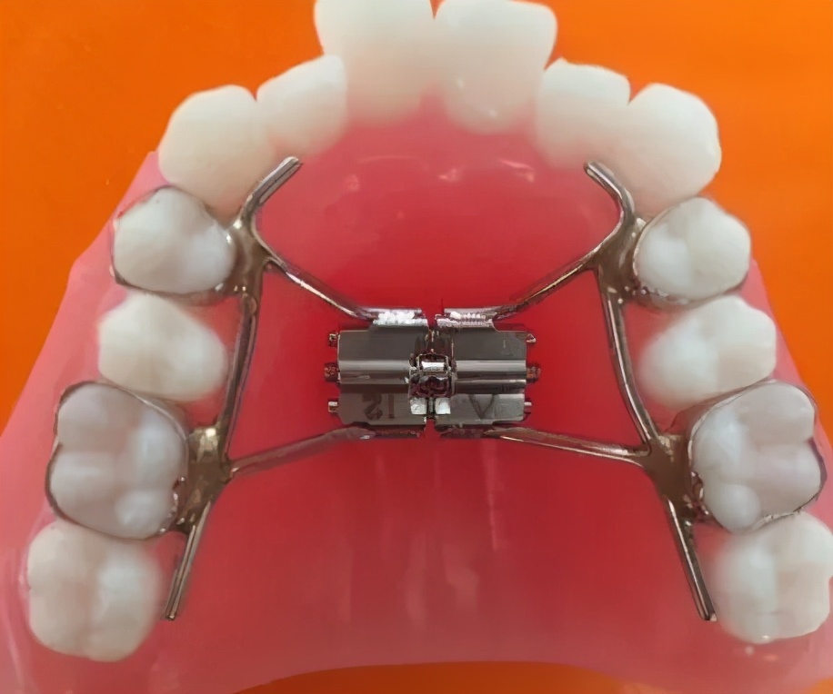 成年人牙齿矫正戴上牙套嘴巴变凸,扩弓会使脸型变大吗