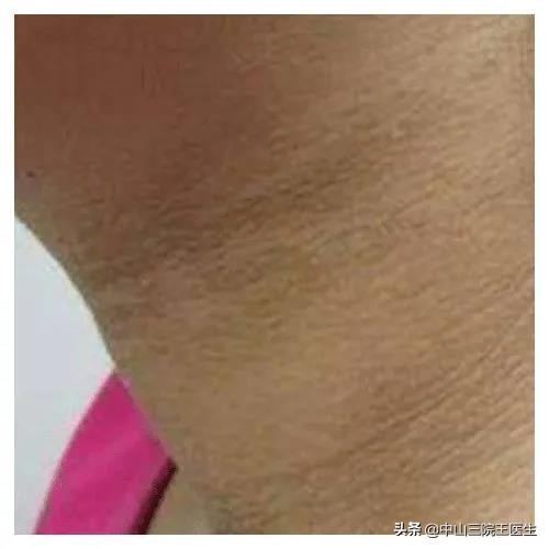 判断是没洗干净还是假性黑棘皮病,黑黑的洗不掉怎么办