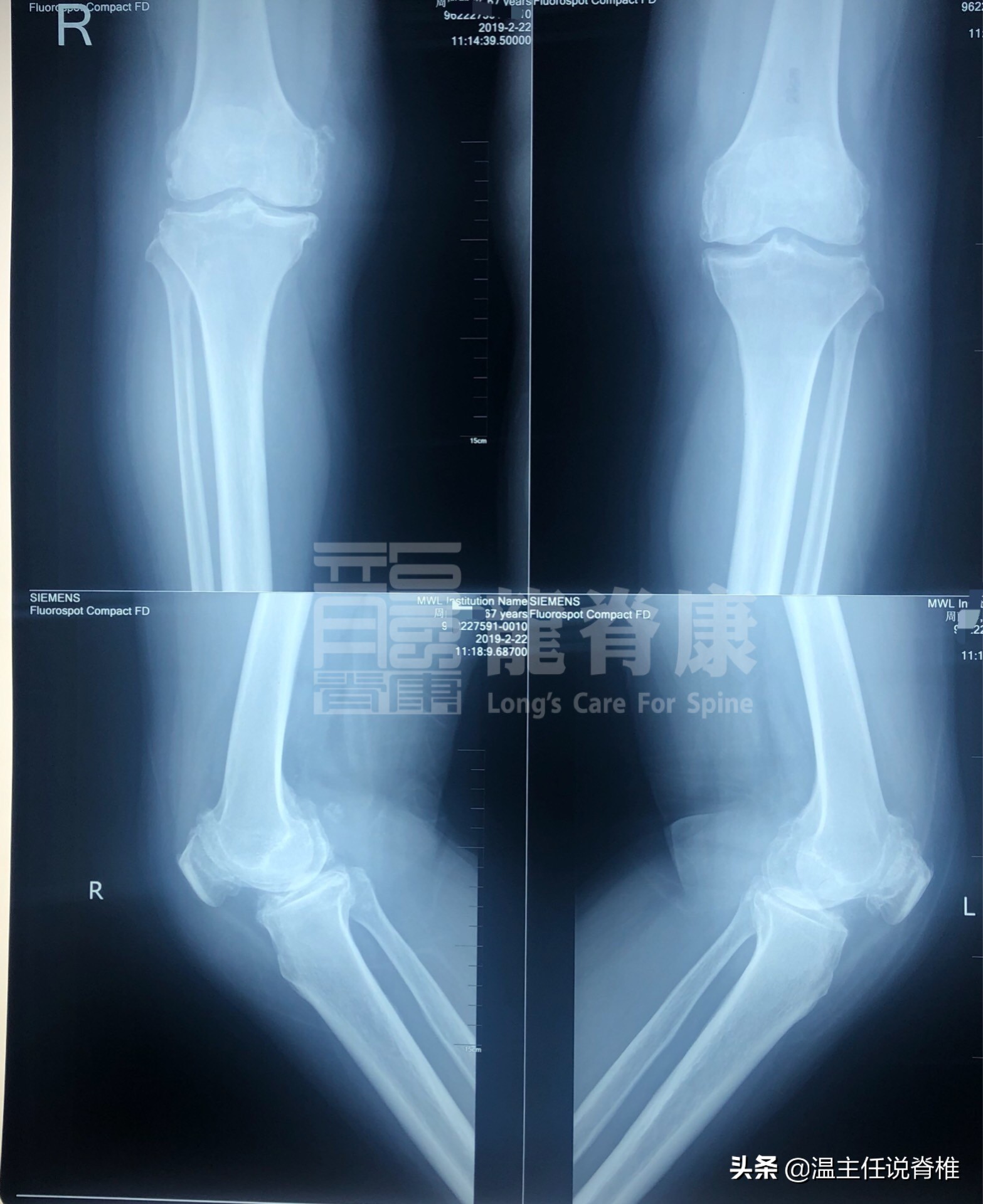 治多种腰痛的方法,腰痛转移到膝盖痛怎么治疗