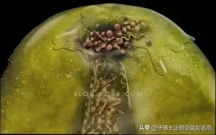 根管治疗难点与解决方案,根管治疗牢固吗