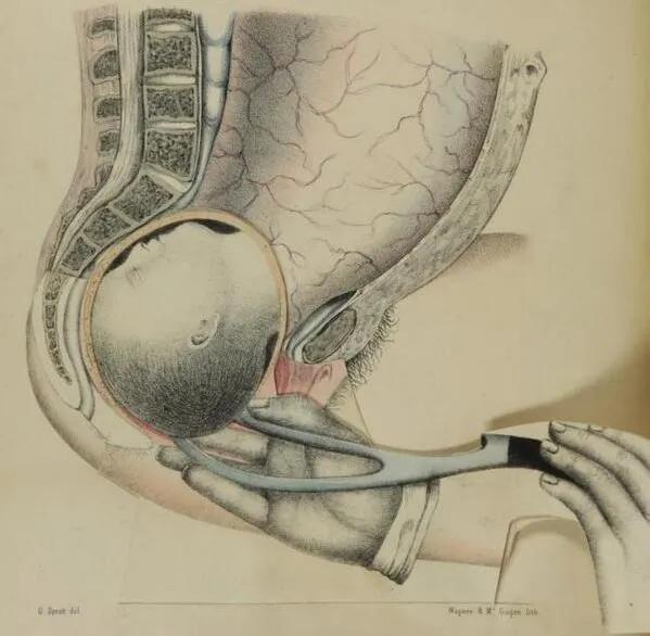 曾经的秘密：被藏起百年的救人利器