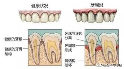 沉默的牙齿杀手牙周病,隐形牙齿杀手图解