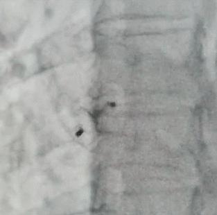 卵圆孔未闭封堵手术会脑血栓吗,心脏卵圆孔封堵术