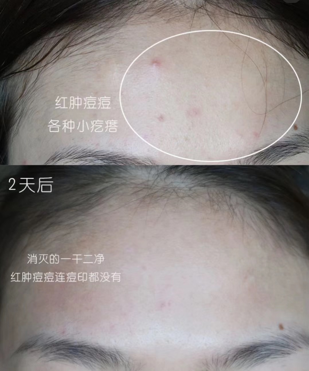 爱长痘的护肤品推荐,爱长痘推荐什么牌子抗老的护肤品