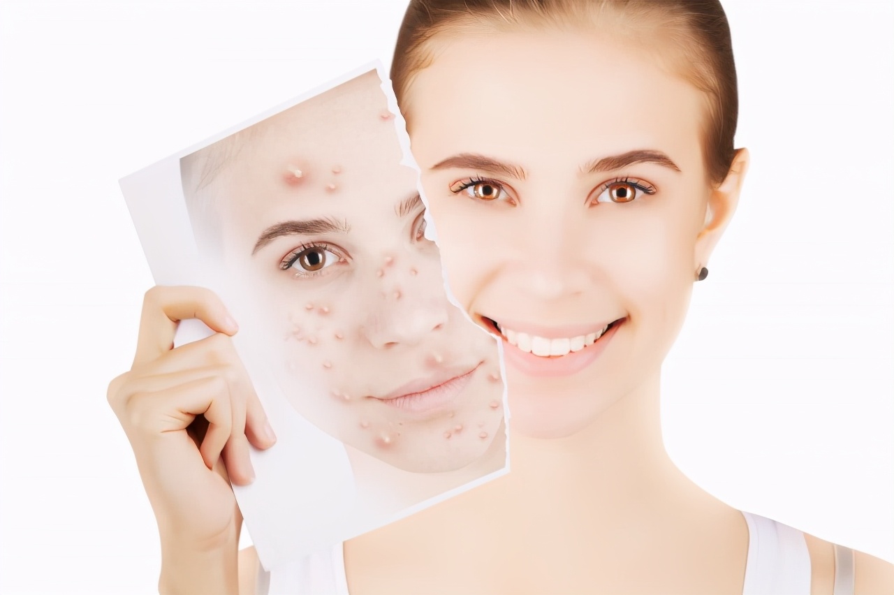 脸部长痘对应五脏六腑,长痘位置对应五脏六腑