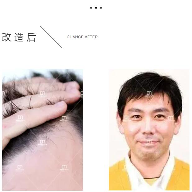 补发片戴着好看吗,补发片科普